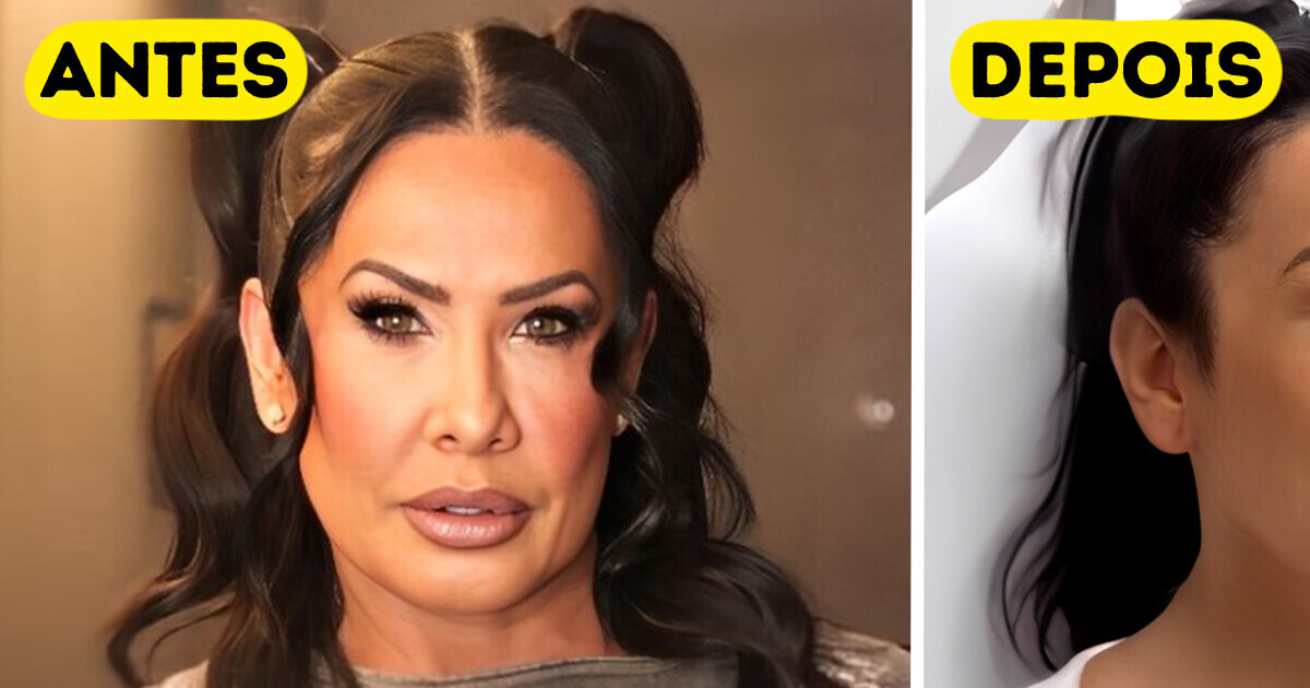 Scheila Carvalho remove ácido hialurônico do rosto e se choca com o resultado: “Meu olhar abriu” Scheila Carvalho remove ácido hialurônico do rosto e se choca com o resultado: “Meu olhar abriu”