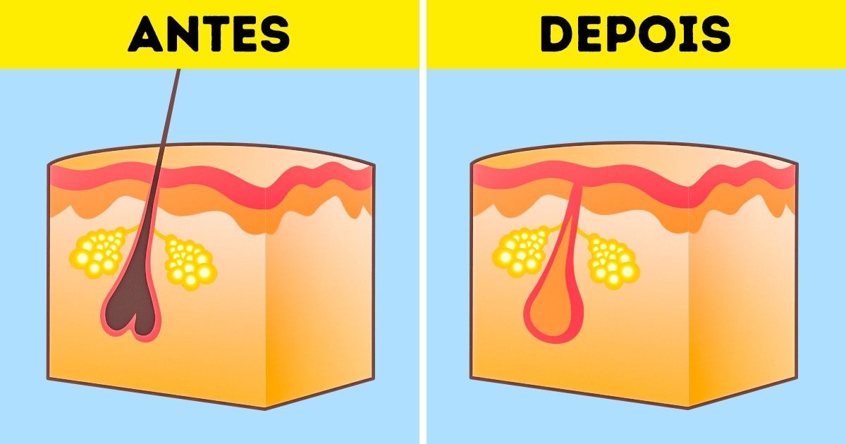 Mitos sobre depilação em que você deve deixar de acreditar