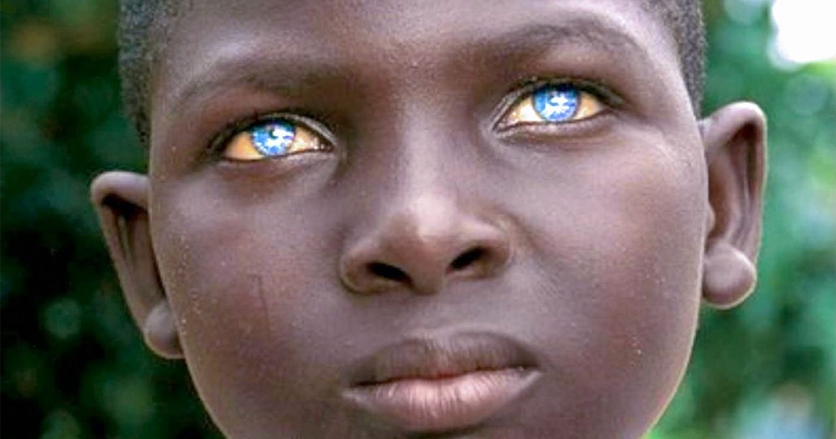 11 Características peculiares da aparência humana que são, na verdade, anomalias genéticas