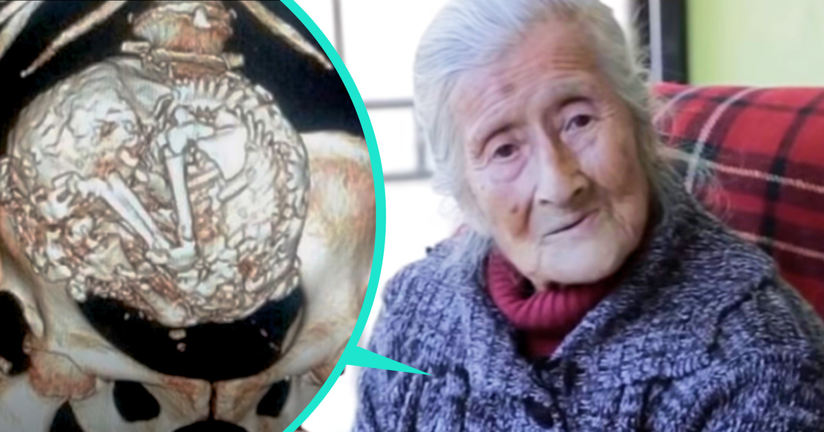 O caso da mulher idosa com mal-estar que acabou se revelando um feto de 50 anos
