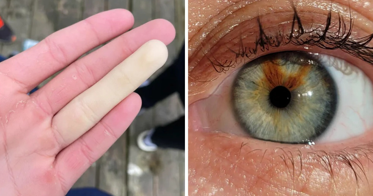 16 Pessoas com marcas únicas que provam a diversidade da natureza