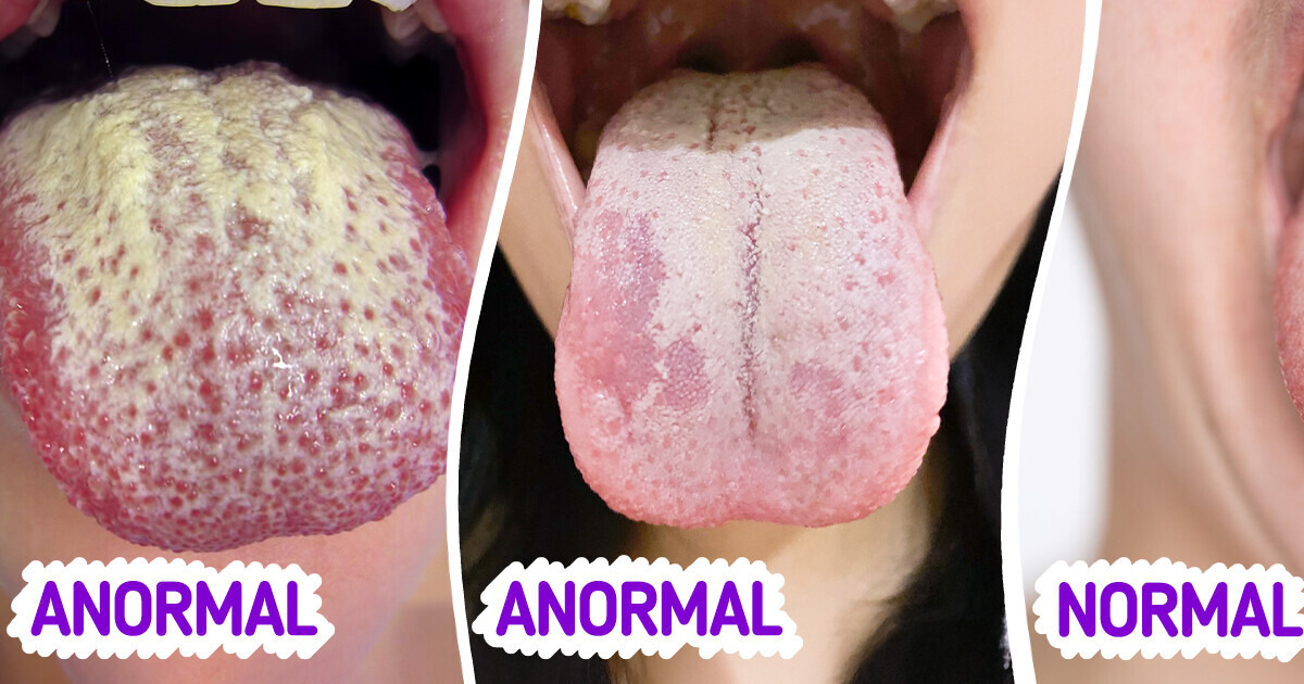 Língua branca: causas e sinais de alerta para sua saúde Língua branca: causas e sinais de alerta para sua saúde