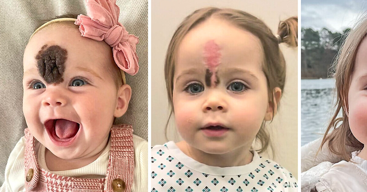Pais optam por uma cirurgia na filha para remover uma marca de nascença rara: “as pessoas olhavam para ela” Pais optam por uma cirurgia na filha para remover uma marca de nascença rara: “as pessoas olhavam para ela”