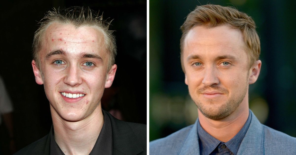 20 Homens famosos que mudaram bastante após a fama