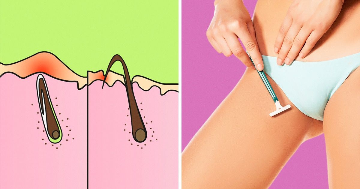 Como se livrar dos pelos encravados e evitar que eles reapareçam