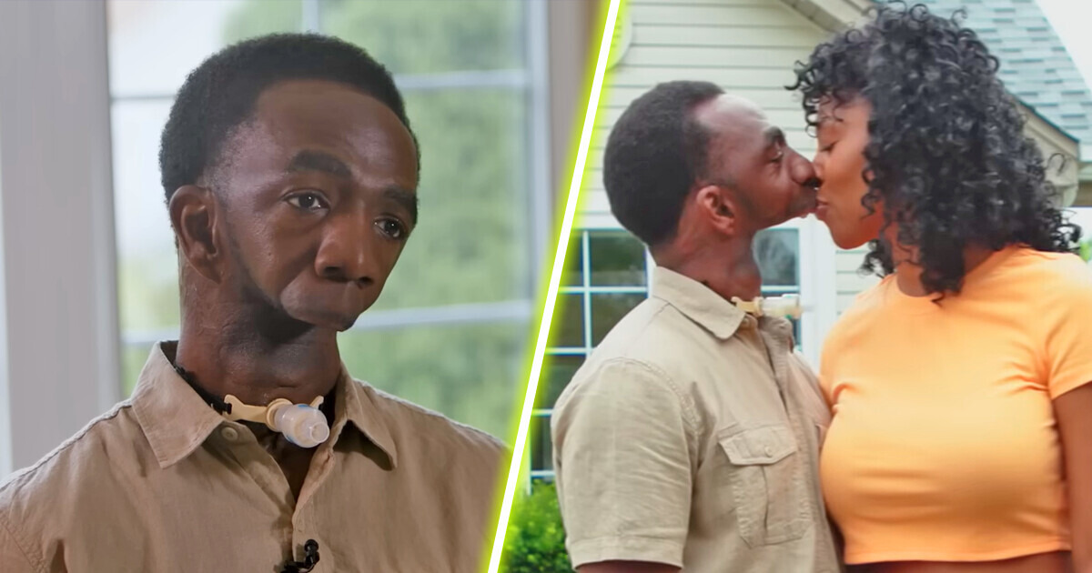 Homem que nasceu sem mandíbula encontra o amor, mas gera polêmica acalorada: “Ela não pode beijá-lo!”