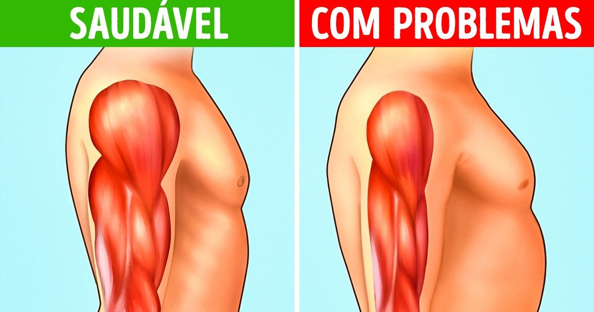 A degeneração muscular começa com 8 sintomas. Saiba quais são A degeneração muscular começa com 8 sintomas. Saiba quais são