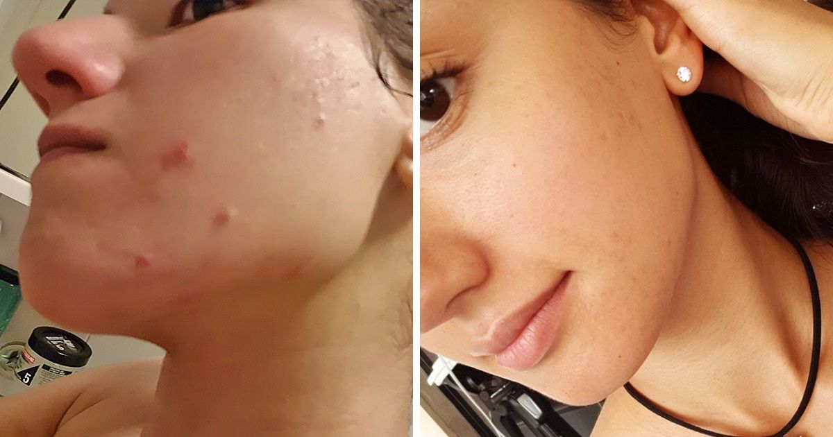 Esta blogueira mostrou a mudança em seu rosto após modificar sua dieta