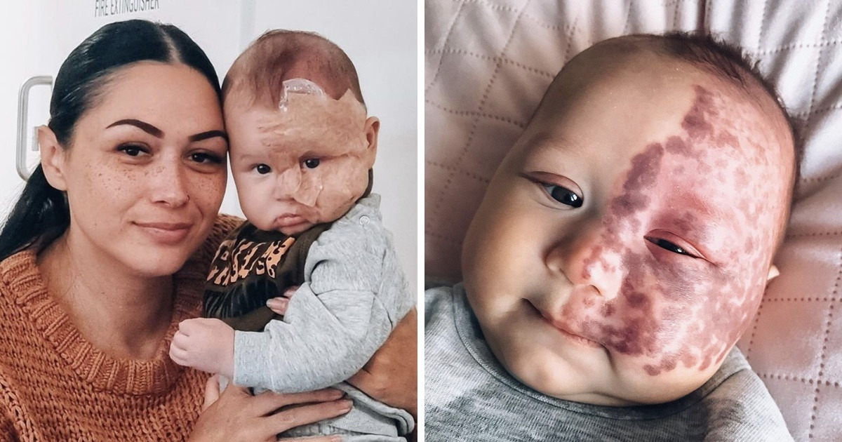 Mãe, que foi perseguida por aplicar laser em uma enorme marca de nascença no rosto de seu bebê, desvenda seus motivos