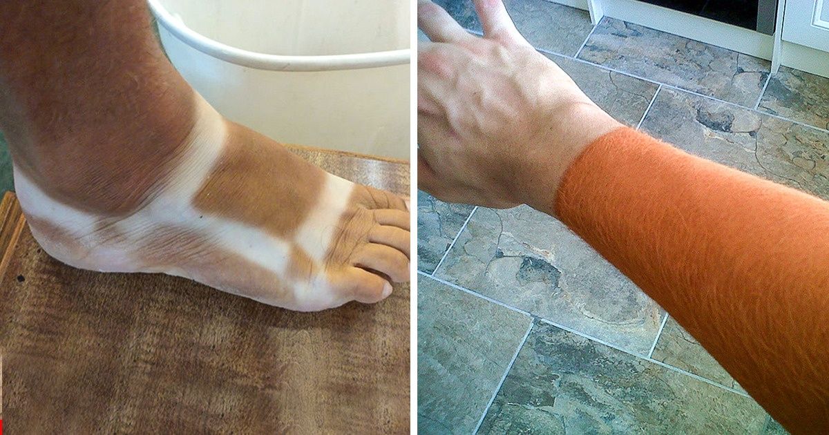 20 Fotos de pessoas que abusaram do sol e ficaram “marcadas” por um bom tempo 20 Fotos de pessoas que abusaram do sol e ficaram “marcadas” por um bom tempo
