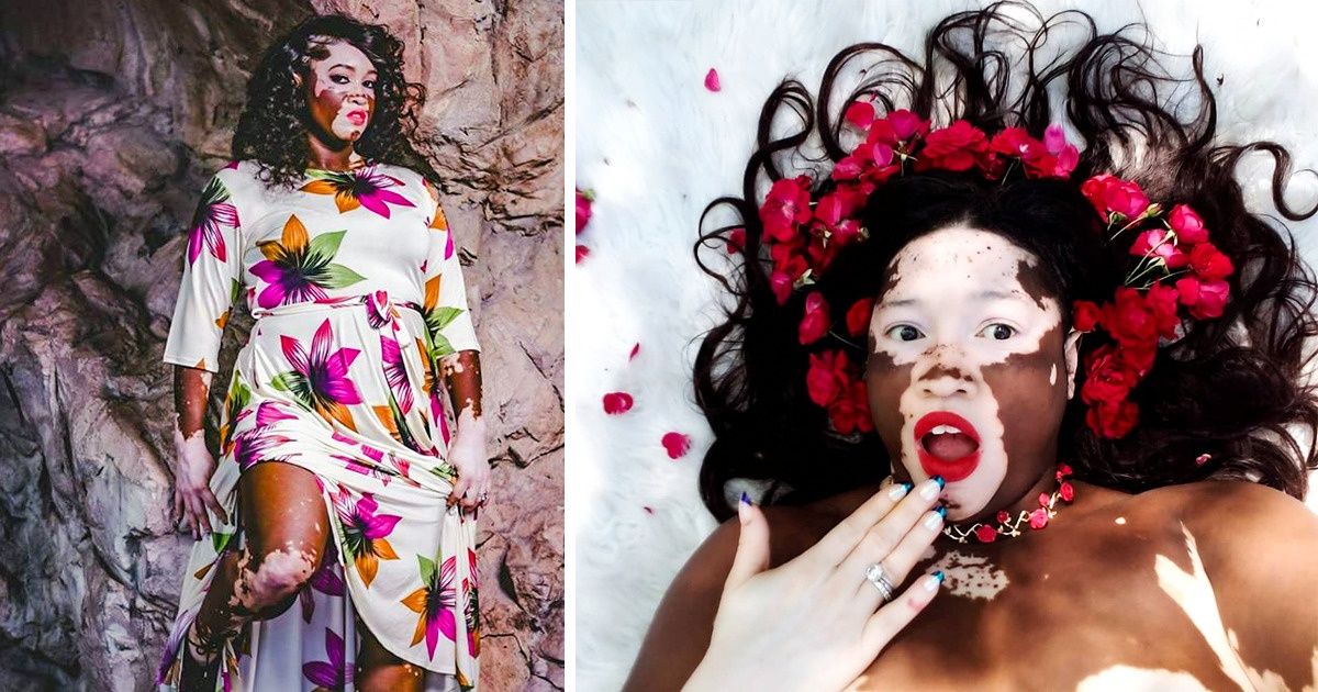 Modelo com vitiligo é inspiração para outras pessoas com a doença Modelo com vitiligo é inspiração para outras pessoas com a doença