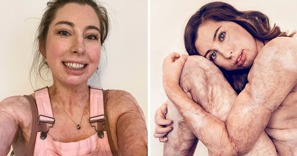 A história de uma mulher que sobreviveu a queimaduras em 96% de seu corpo e abalou o setor de beleza