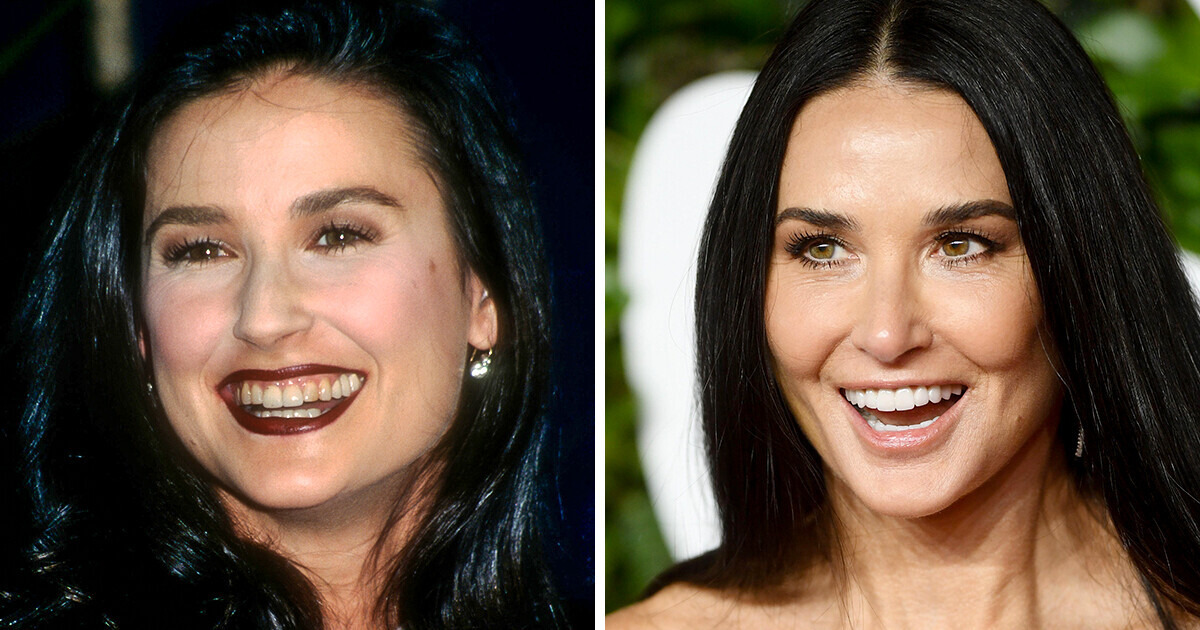 15 Estrelas que tinham dentes tortos e agora são donos do “sorriso de Hollywood”