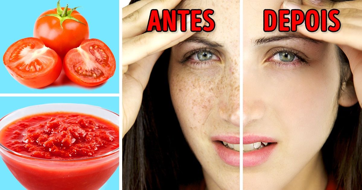 Dicas para se livrar das manchas solares com produtos naturais