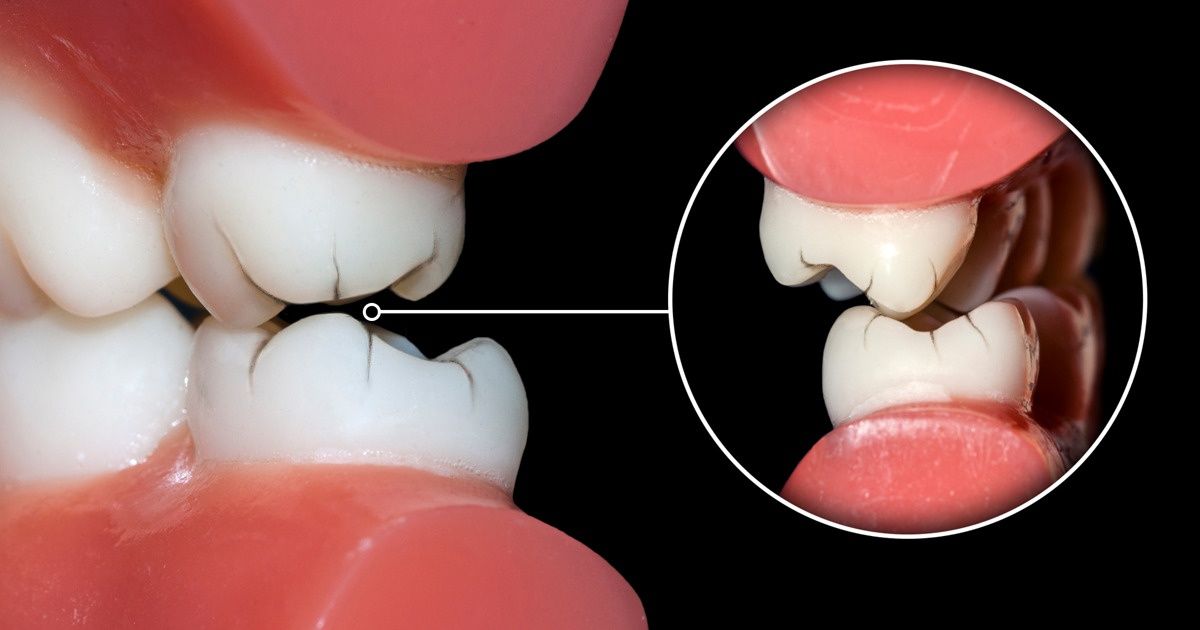Como deixar de ranger os dentes durante a noite