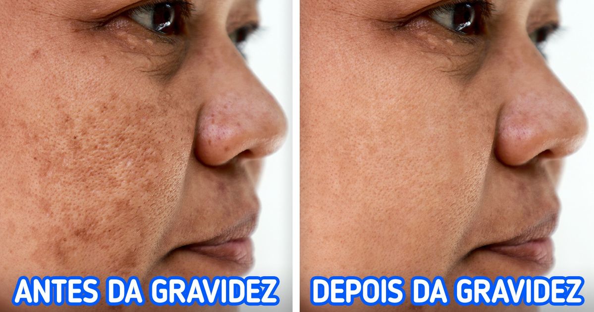 O que pode causar manchas na pele (e quatro formas de evitá-las) O que pode causar manchas na pele (e quatro formas de evitá-las)