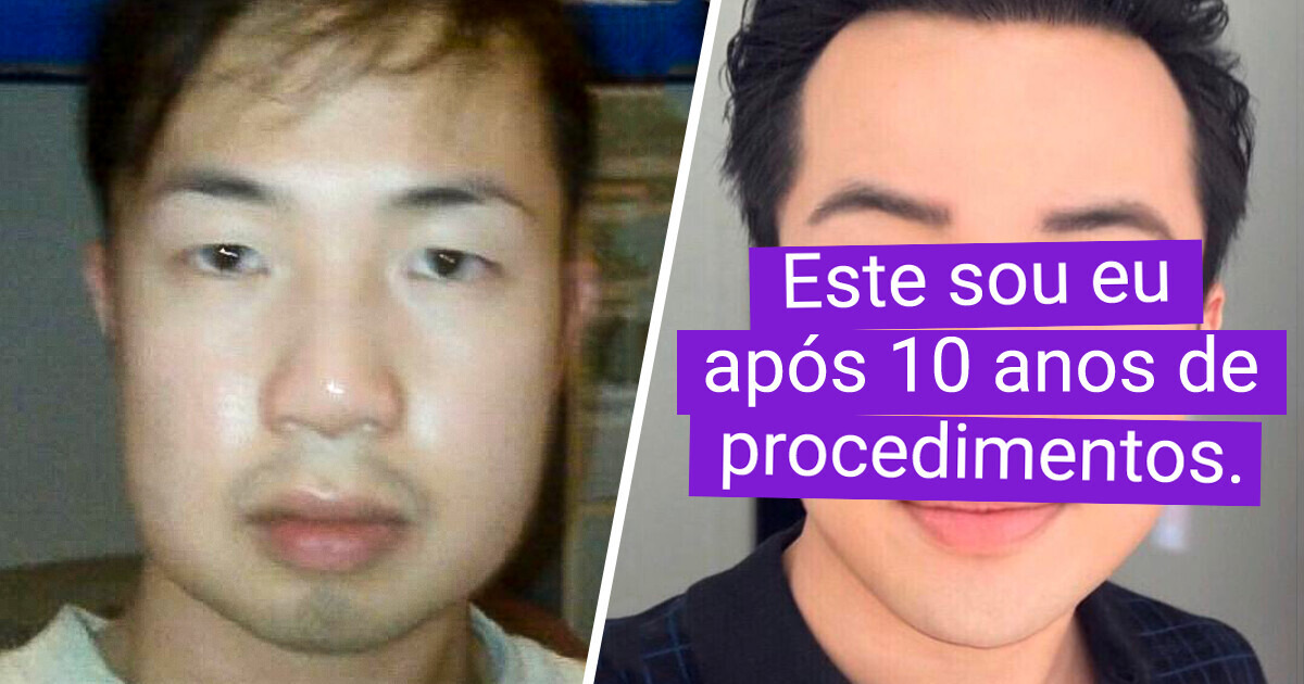 Transformado pela cirurgia plástica, homem encontra o verdadeiro sentido da felicidade Transformado pela cirurgia plástica, homem encontra o verdadeiro sentido da felicidade