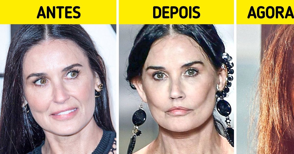 12 Celebridades que decidiram parar de alterar a sua aparência com cirurgias e preenchimentos