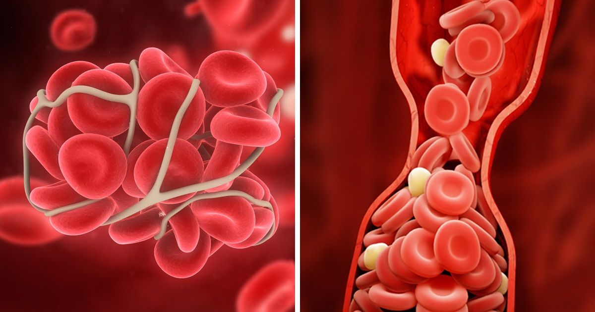 10 Maneiras de prevenir a formação de coágulos sanguíneos e evitar danos à saúde