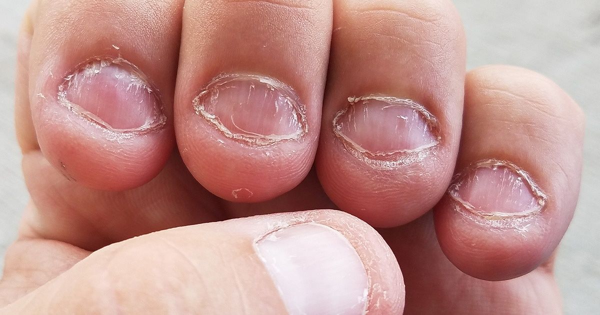 10 Dicas para você parar de roer as unhas de uma vez por todas 10 Dicas para você parar de roer as unhas de uma vez por todas