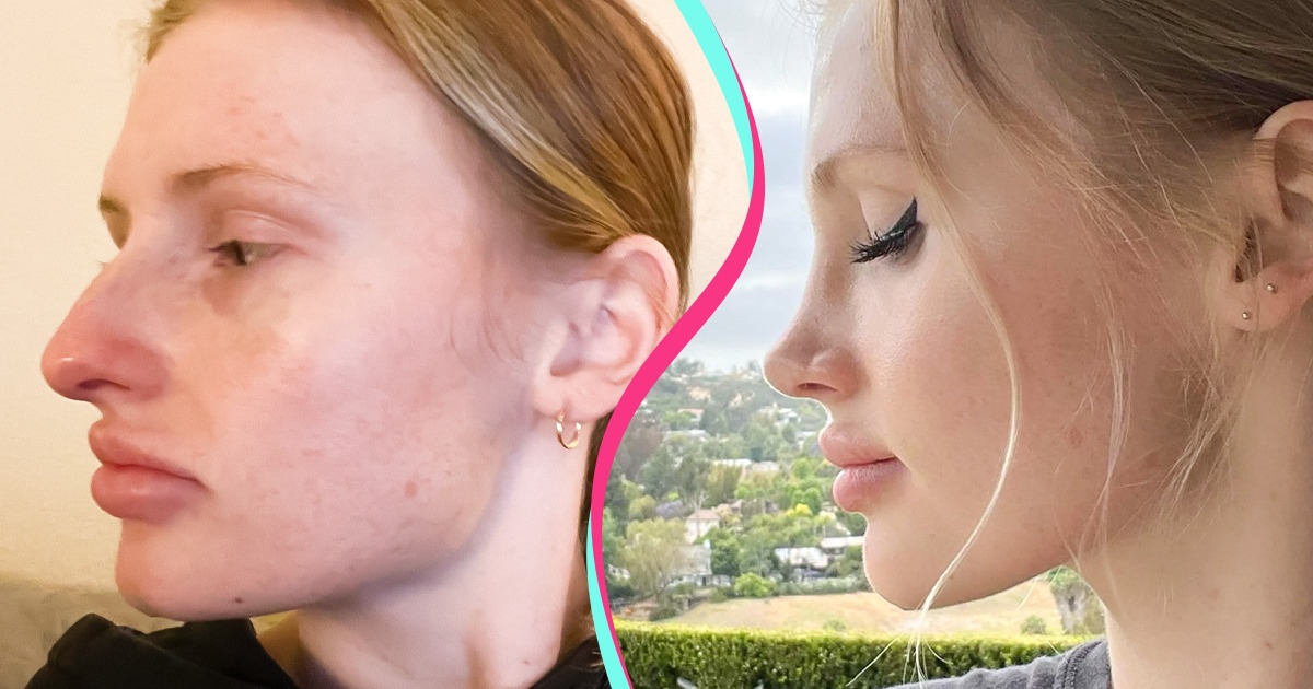 17 Internautas que optaram por fazer cirurgias para que se sentissem melhor consigo mesmas