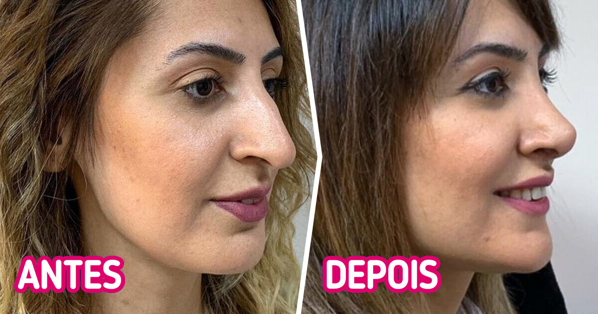 20+ Mulheres que mudaram apenas um detalhe no nariz e ficaram irreconhecíveis