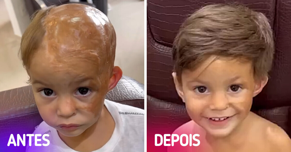 Cabeleireiro paulista dá apliques de cabelo de graça para crianças que perderam seus cabelos por acidentes ou doenças Cabeleireiro paulista dá apliques de cabelo de graça para crianças que perderam seus cabelos por acidentes ou doenças