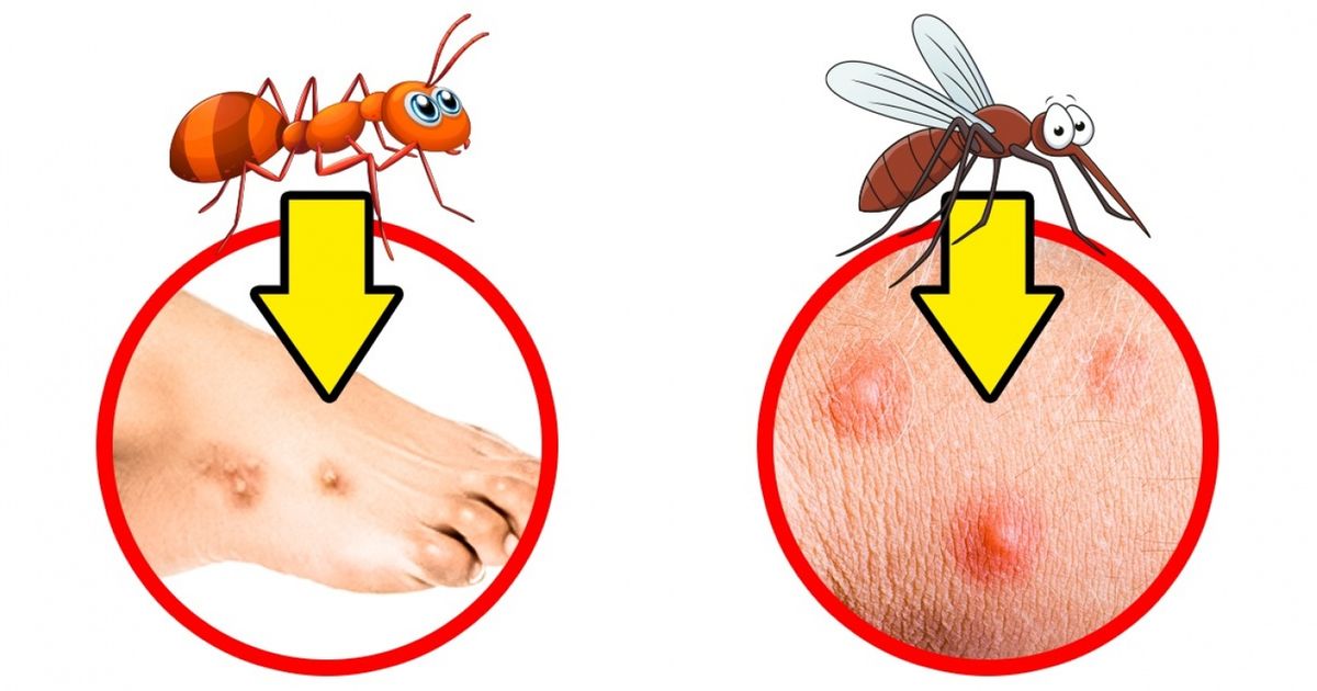 Как понимать муху. Укус насекомых постельный клоп. Как выглядят укусы клопами и мошками. Как выглядят следы от укусов клопов. Укус муравья на коже человека.