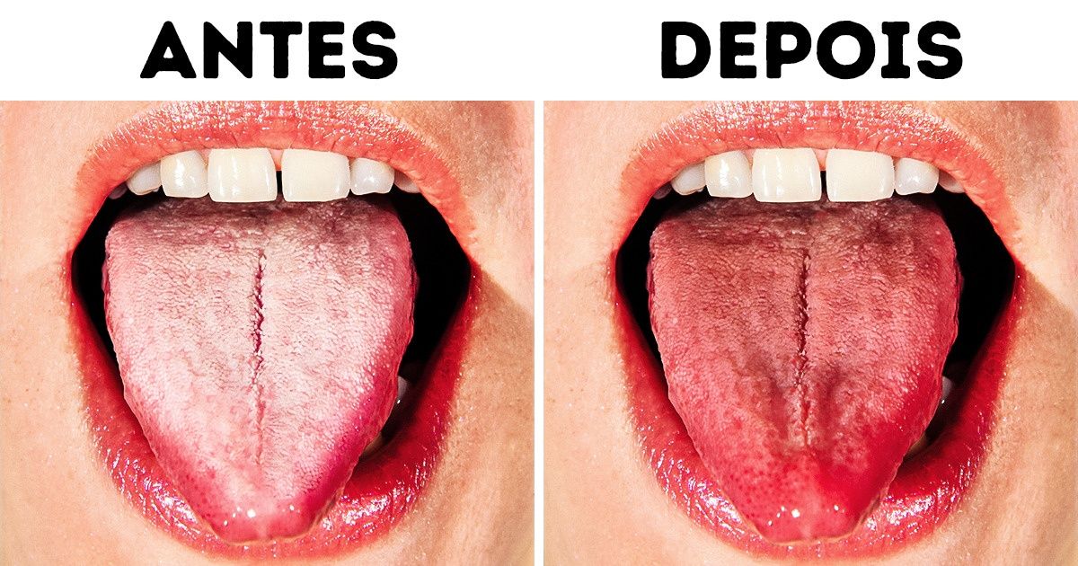 10 Maneiras de ter uma língua mais saudável e evitar seu embranquecimento