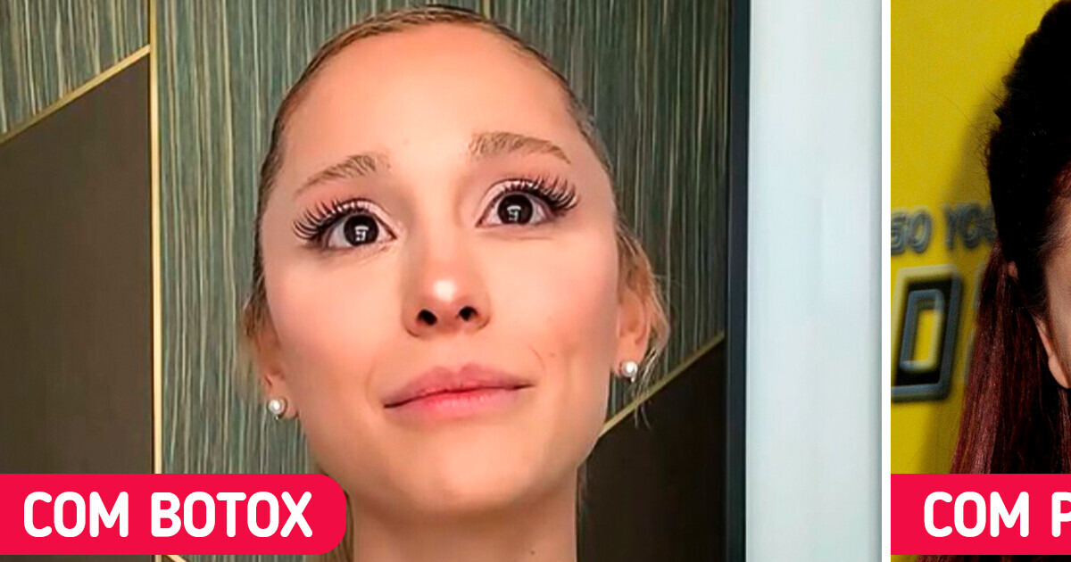 Ariana Grande admite ter usado “uma tonelada de preenchimentos e botox” e explica por que parou com isso Ariana Grande admite ter usado “uma tonelada de preenchimentos e botox” e explica por que parou com isso