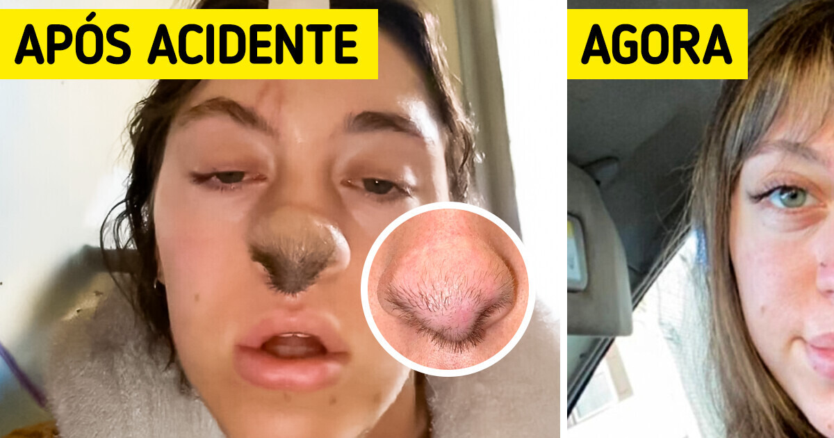 Fui atacada por um cão - e agora crescem cabelos no meu nariz Fui atacada por um cão - e agora crescem cabelos no meu nariz