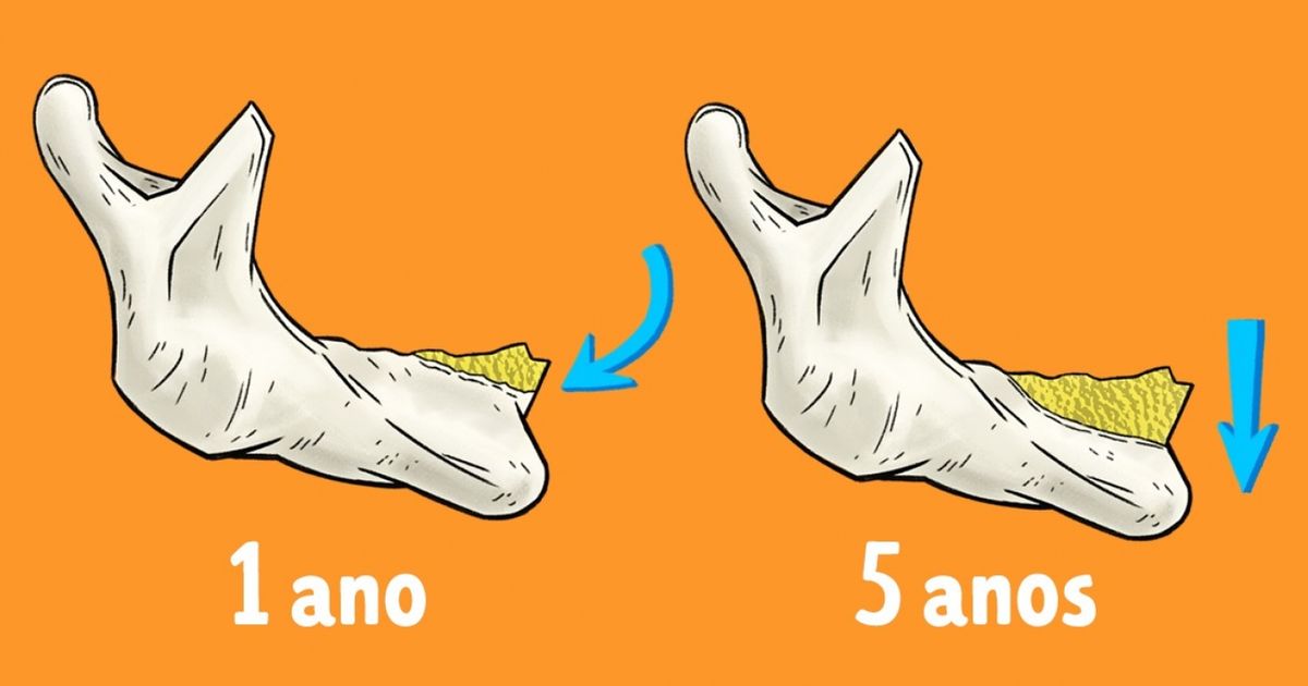 Isto é o que acontece quando perdemos todos os dentes