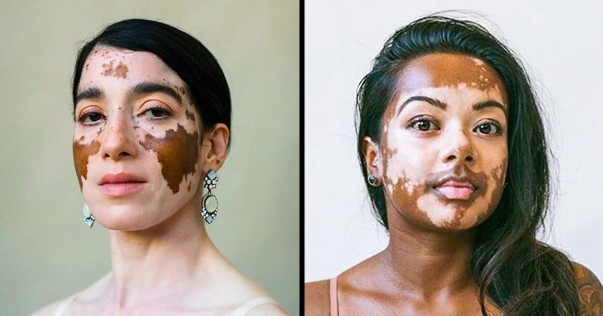 Uma fotógrafa mostra toda a beleza de mulheres com vitiligo Uma fotógrafa mostra toda a beleza de mulheres com vitiligo