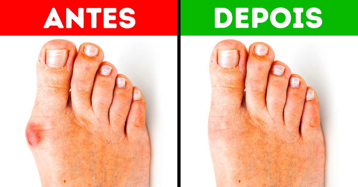 5 Dicas para aliviar a dor no joanete