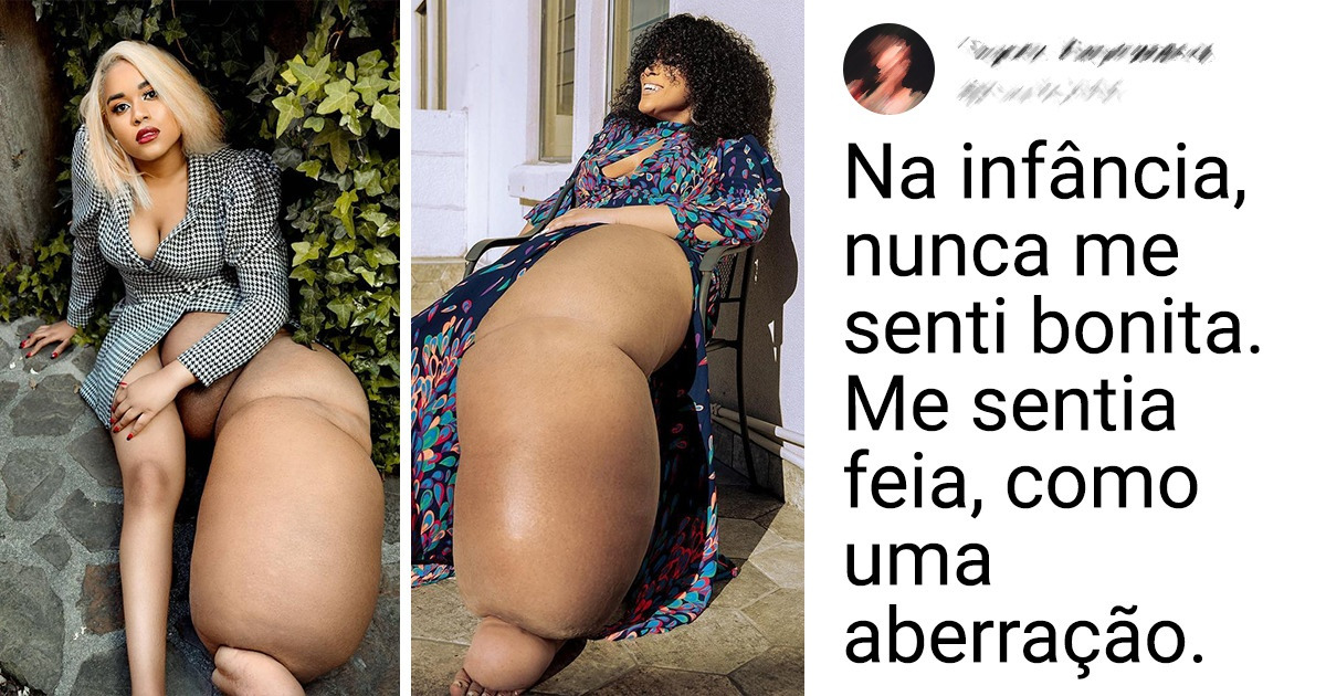 Com condição que causou aumento de uma das pernas, jovem quer fazer carreira como modelo e servir de inspiração Com condição que causou aumento de uma das pernas, jovem quer fazer carreira como modelo e servir de inspiração
