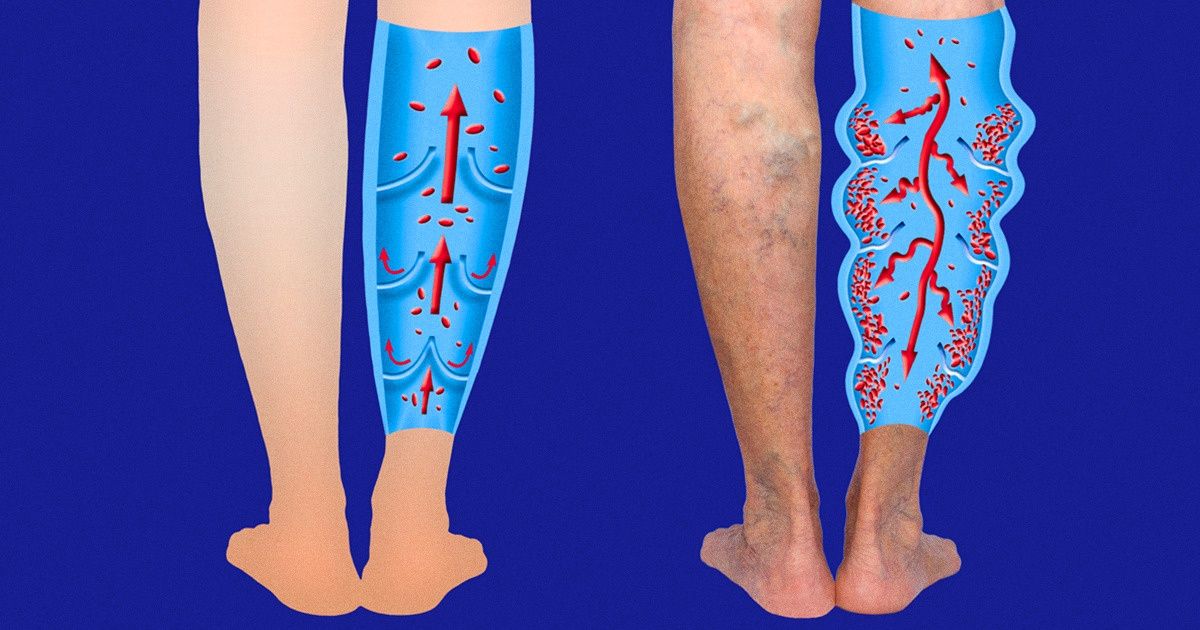 7 Exercícios que ajudam a reduzir as aranhas vasculares e as varizes