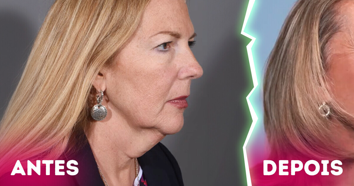 Aos 59 anos, mulher faz lifting facial e impressiona com visual rejuvenescido: '20 anos a menos!' Aos 59 anos, mulher faz lifting facial e impressiona com visual rejuvenescido: '20 anos a menos!'