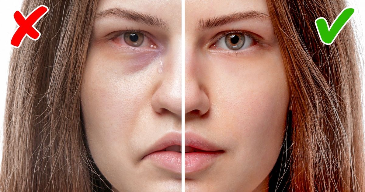 Sinais no rosto que costumam refletir problemas de saúde Sinais no rosto que costumam refletir problemas de saúde