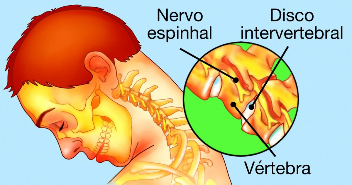 9 Soluções que lhe ajudarão a se livrar da dor no pescoço