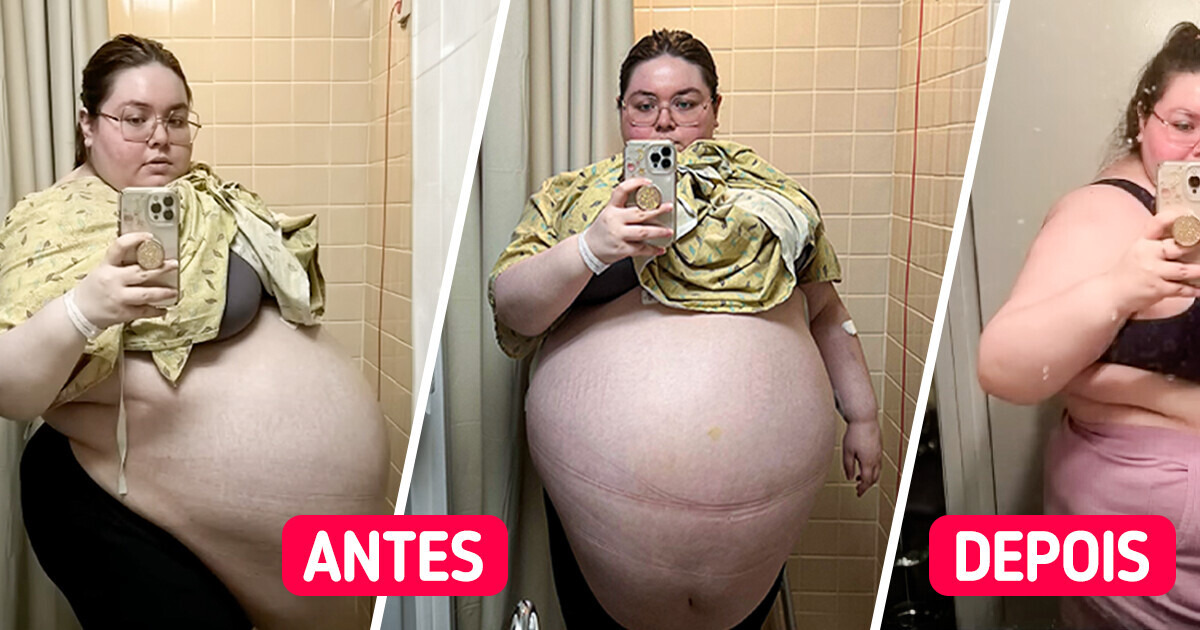 "Não conseguia deitar de barriga para baixo": A descoberta chocante de um tumor pesando 47 quilos "Não conseguia deitar de barriga para baixo": A descoberta chocante de um tumor pesando 47 quilos