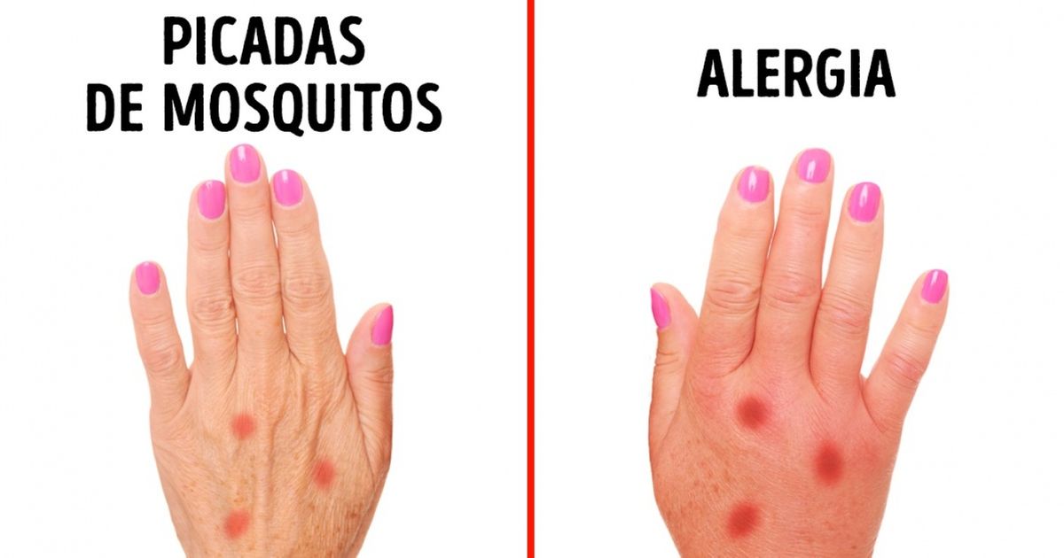 3 sinais que ajudam a identificar uma alergia