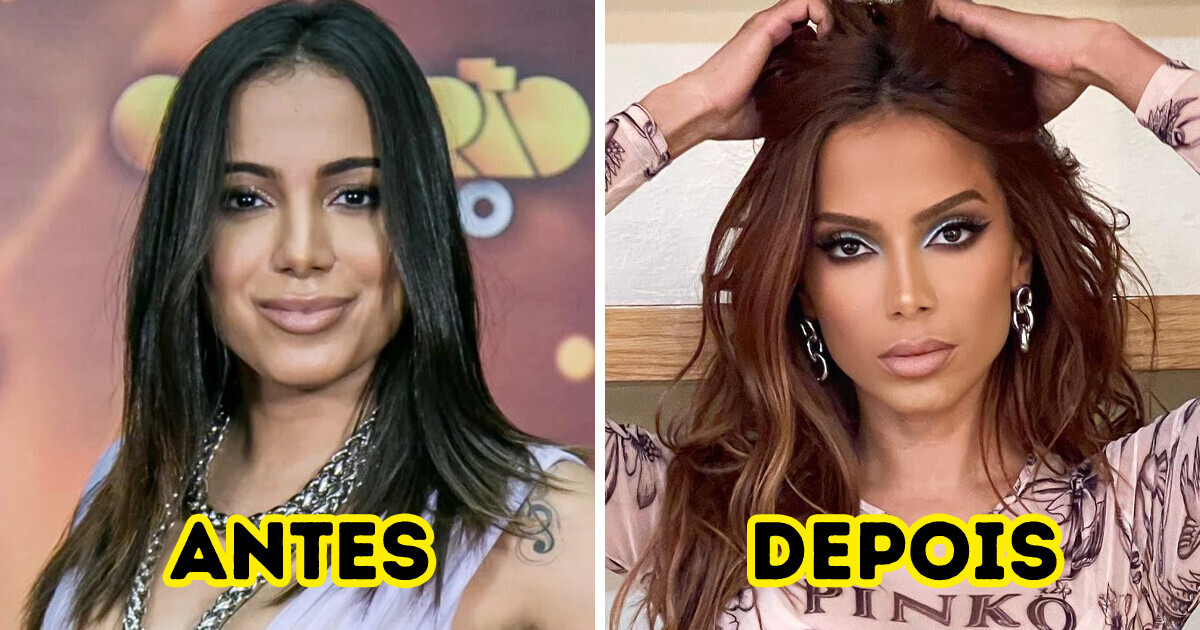 12 Famosos que não tiveram medo da mudança e se submeteram a procedimentos estéticos 12 Famosos que não tiveram medo da mudança e se submeteram a procedimentos estéticos