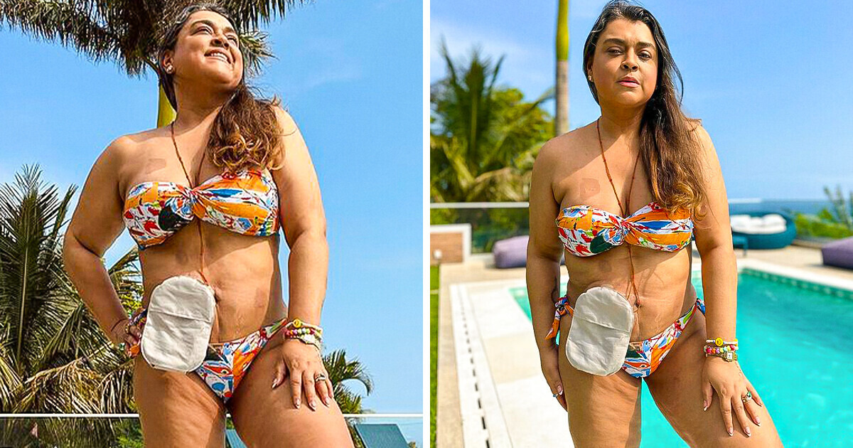 Preta Gil compartilha fotos com a sua bolsa de ileostomia e solta mensagem inspiradora