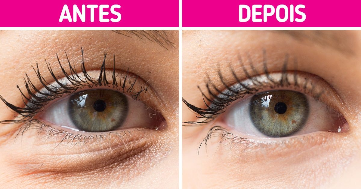 Entenda por que as olheiras aparecem e saiba como fazer para atenuá-las