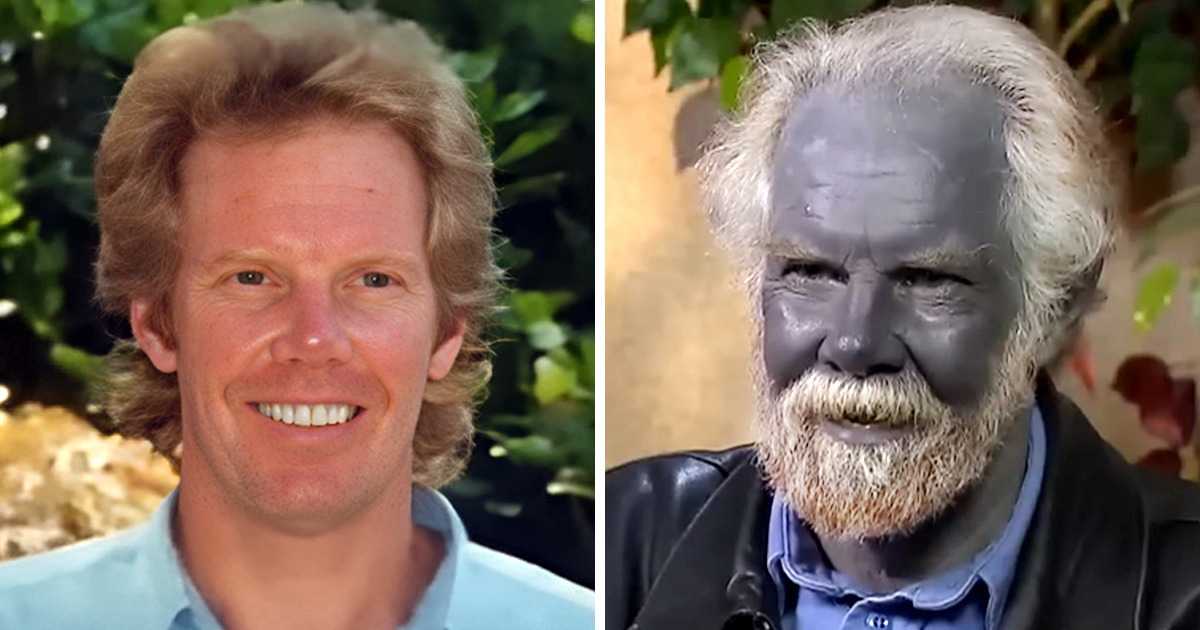 A inusitada condição médica que deixou um homem com a pele azul permanentemente A inusitada condição médica que deixou um homem com a pele azul permanentemente