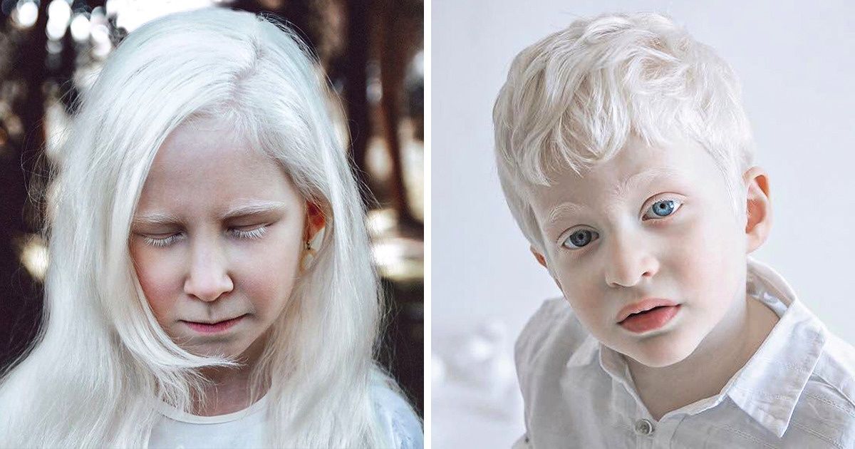 Fotógrafa captura imagens de pessoas com albinismo para mostrar sua beleza formidável e única Fotógrafa captura imagens de pessoas com albinismo para mostrar sua beleza formidável e única