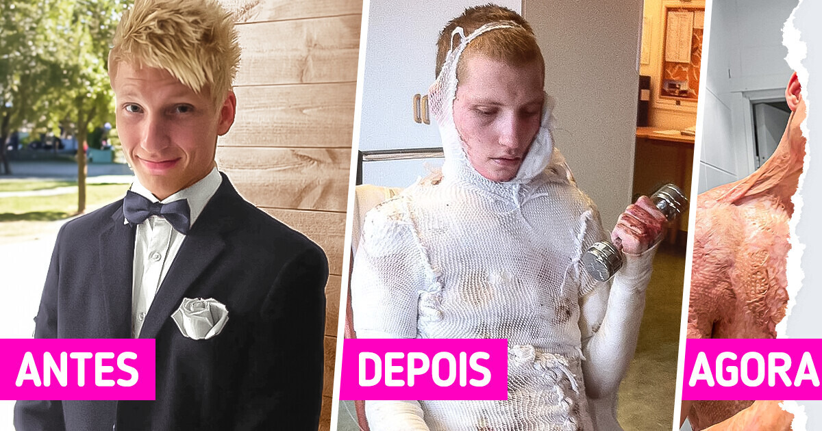 “Eu me culpo”: Cantor aceita seu novo visual depois de ter a maior parte de seu corpo eletrocutada