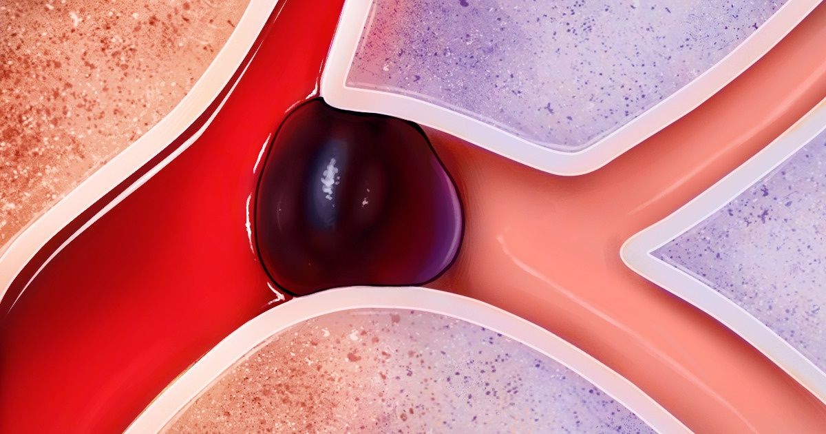 8 Maneiras de prevenir derrames e se livrar das dores de cabeça