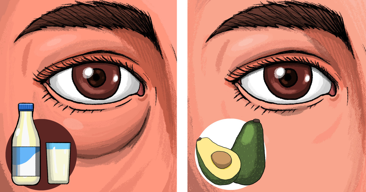 6 Alimentos que podem causar inchaço nos olhos (e 4 que podem resolver o problema)