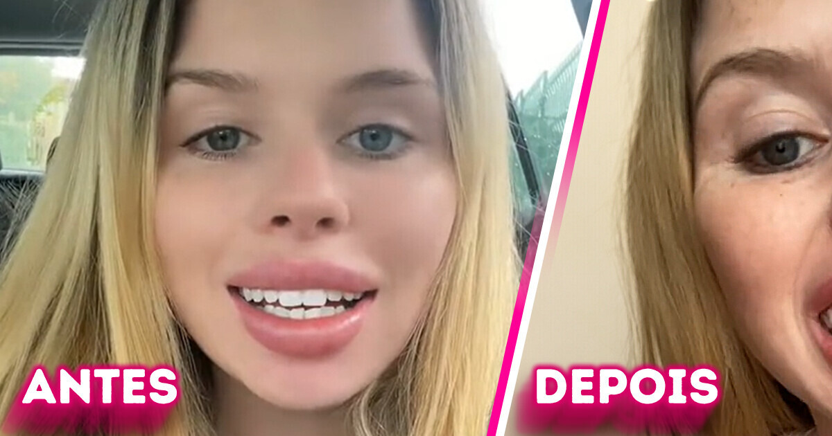 “Pareço um cavalo”- Mulher paga barato por facetas dentárias e se arrepende “Pareço um cavalo”- Mulher paga barato por facetas dentárias e se arrepende